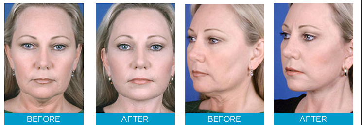 instant face lift